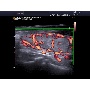 Accuvix A30 - Power Doppler kép